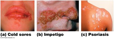 Examples of skin infections and allergies: cold sores, impetigo, psoriasis