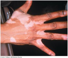 Vitiligo: patchy loss of skin pigmentation on hand