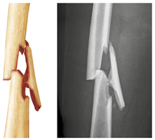 Common types of fractures