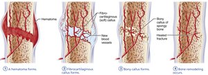 Stages in the healing of a bone fracture