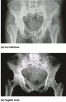 Moth-eaten appearance of bone with Paget’s disease