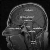 MRI of brain showing hypothalamus and pituitary gland