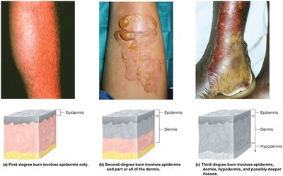 Burn classification and skin layers affected