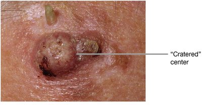 Basal cell carcinoma with cratered center