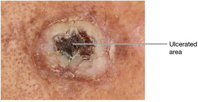 Squamous cell carcinoma with ulcerated area