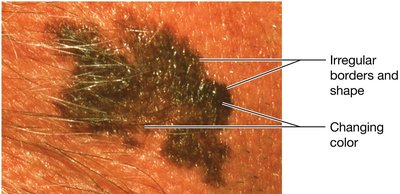 Malignant melanoma with irregular borders and color
