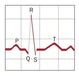 ECG tracing showing P, QRS, and T waves