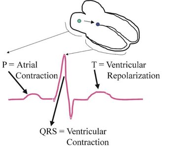 ECG tracing with labeled waves and intervals