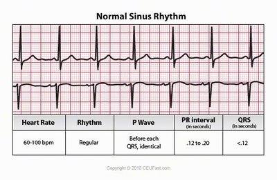 Normal sinus rhythm ECG strip