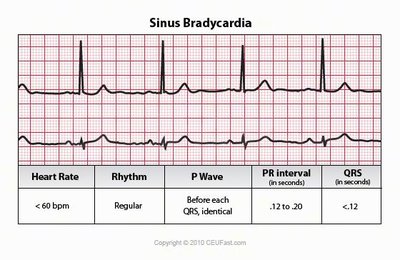 Sinus bradycardia ECG strip