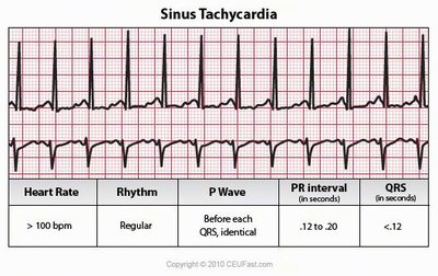 Sinus tachycardia ECG strip