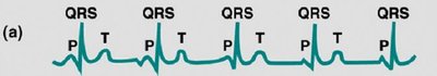 Normal ECG with P, QRS, and T waves