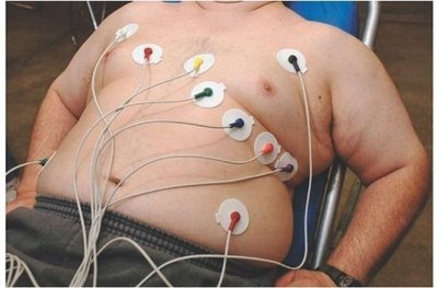 ECG electrodes placed on the chest