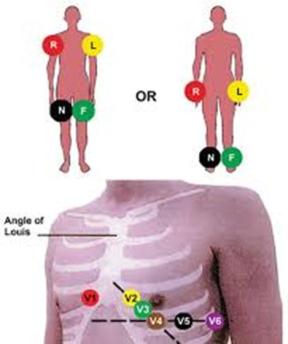 ECG electrode placement diagram