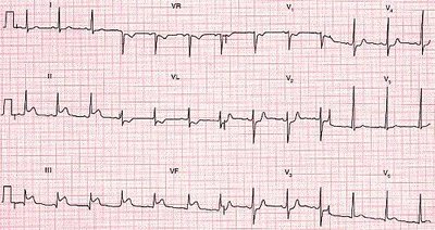 ECG tracing with multiple leads