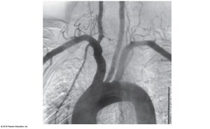 Aortic arch and its branches