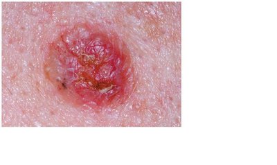 Basal cell carcinoma lesion