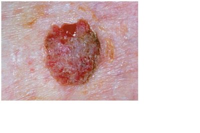 Squamous cell carcinoma lesion