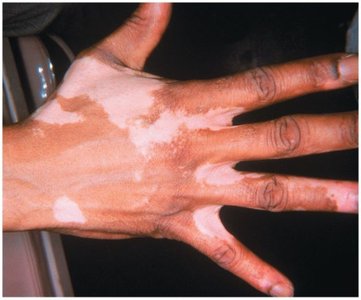 Vitiligo on the hand