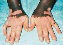 Vitiligo on both hands