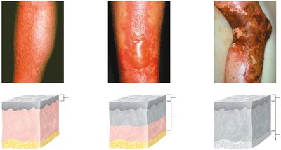 First, second, and third-degree burns