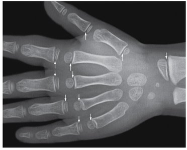 X-ray of growing epiphyseal cartilages
