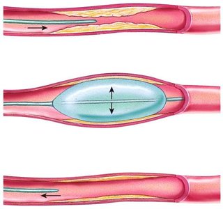 Angioplasty procedure