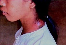 Image of swollen lymph node (bubo)