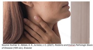 Image of enlarged cervical lymph nodes