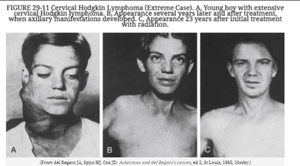 Images of Hodgkin lymphoma cases