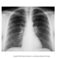 Chest X-ray