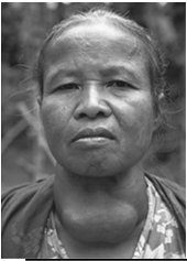 Iodine deficiency (goiter)