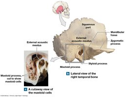 Lateral view and mastoid cells of right temporal bone