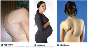 Kyphosis, lordosis, scoliosis