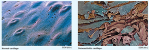 Normal vs osteoarthritic cartilage