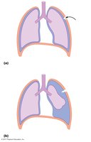 Pneumothorax: loss of negative intrapleural pressure