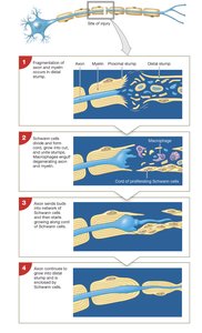 Steps in nerve regeneration after injury (Wallerian degeneration)