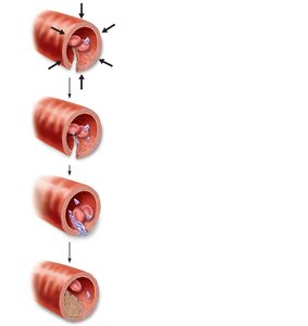 Scanning electron micrograph of erythrocytes trapped in a fibrin mesh