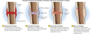 Steps in fracture repair