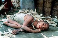 Child with cretinism (hypothyroidism)