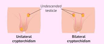 Diagram of unilateral and bilateral cryptorchidism