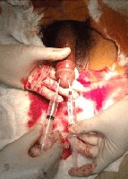 Penile medical procedure