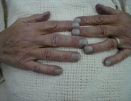 Cyanosis (bluish discoloration of the skin)