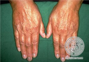 Bronzing of the skin (Addison's disease)
