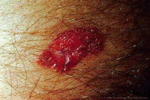 Basal cell carcinoma lesion