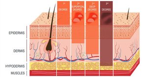 Diagram of burn degrees and affected skin layers