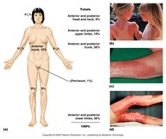 Rule of Nines diagram for burn assessment