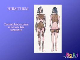 Hirsutism distribution diagram