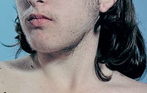 Hirsutism in a young male