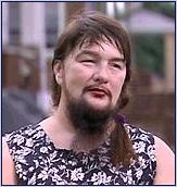 Hirsutism in a female